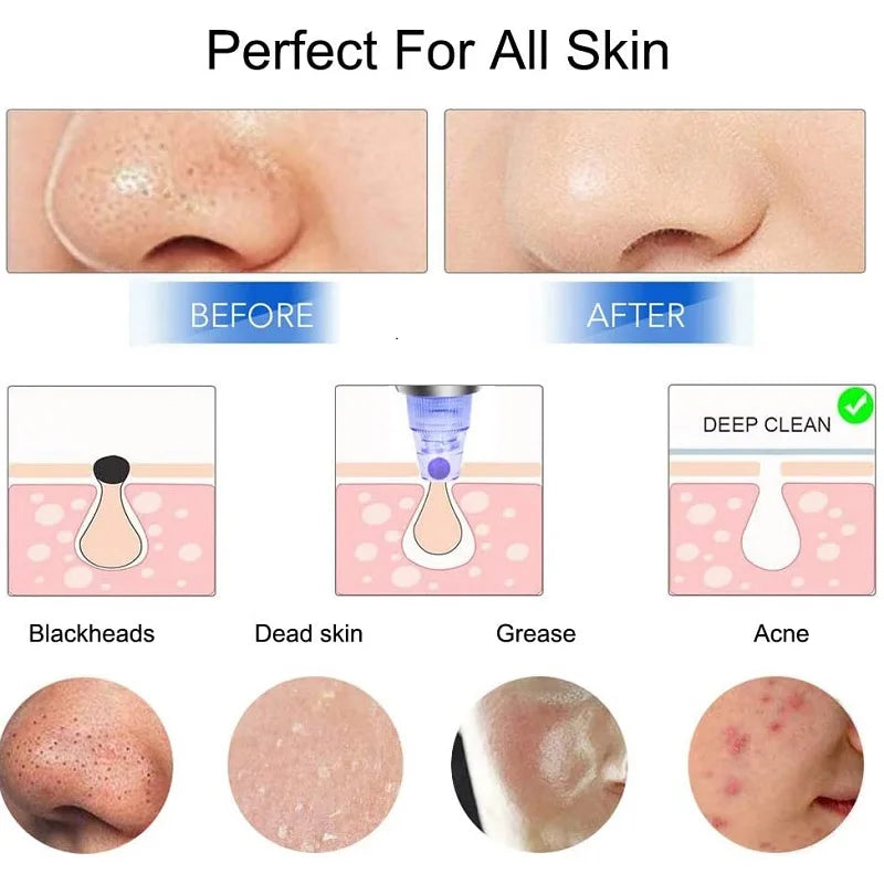 Blackhead Remover Vacuum – T-Zone Deep Clean Tool