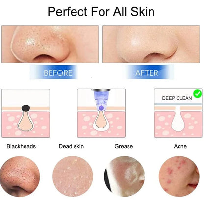 Blackhead Remover Vacuum – T-Zone Deep Clean Tool